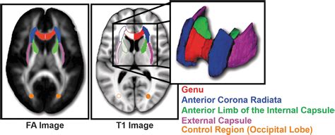 Increased White Matter Coherence Following Three And Six Months Of