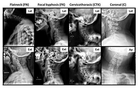 Jcm Free Full Text Surgical Strategy For The Management Of Cervical Deformity Is Based On