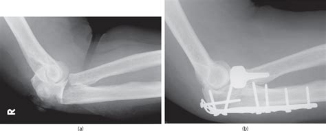 Proximal Forearm Fractures And Elbow Dislocations Musculoskeletal Key