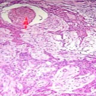 Histopathological Examination Of The Same Patient Showing PNI The Red