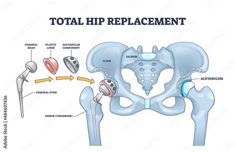 Fotografering Billede Total Hip Replacement Surgery With Anatomical