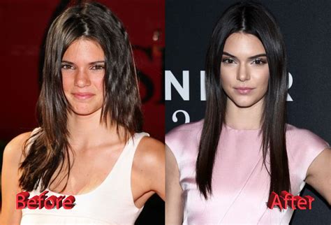 Kendall Jenners Plastic Surgery Procedures