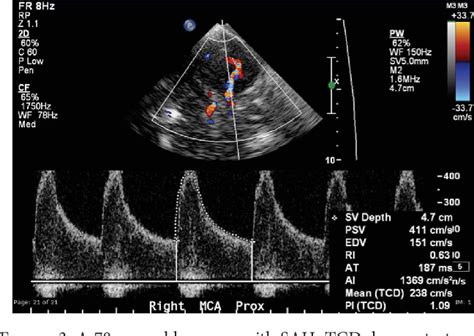 Transcranial Doppler Ultrasound