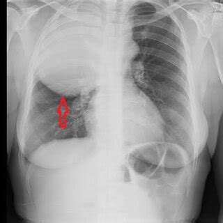 Posterior Anterior Chest X Ray A Large Defined Opasity In The Right