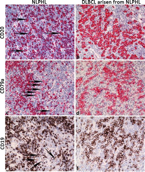 B Cell Phenotype In Composite Lymphomas Of Nlphl And “lp Type” Dlbcl