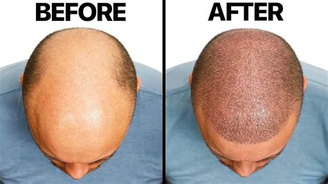 Surgeon Reacts To A Bald Man Gets A Hair Transplant Buzzfeed Gentnews