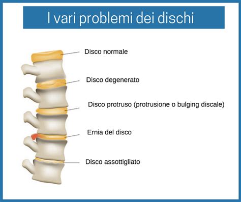 Discopatia O Protrusione L5 S1 Sintomi Ed Esercizi Esercizi Ernia