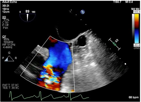 Upper Esophageal Aortic Arch Short Axis Tee Color Doppler View Showing