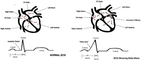 Management of asymptomatic ventricular preexcitation - PMC