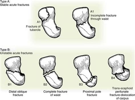 Scaphoid Tubercle