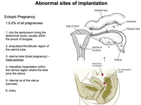 Ectopic Pregnancy Case Flashcards Quizlet