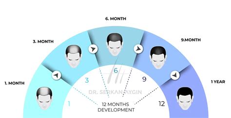 hair transplant growth chart hair transplant recovery timeline