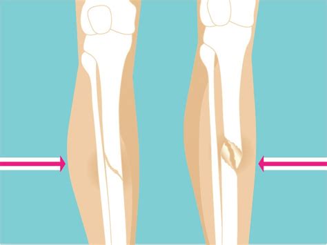 Spiral Fracture Healing Time Tibia And Fibula