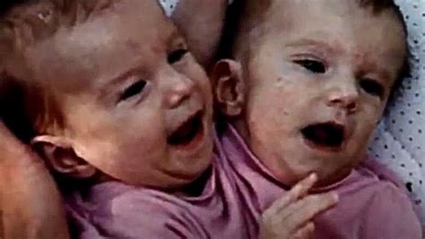 Years After These Siamese Twins Were Born They Shared Shocking News