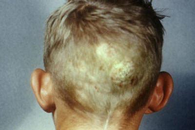 Tinea Capitis (Scalp Ringworm) - Causes, Symptoms, Pictures and Treatment