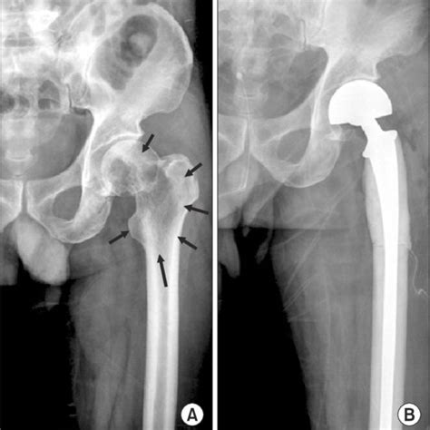 A Pre Operative Radiograph Of Trochanteric Pathologic Fracture Of The