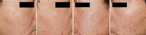 Revitalizing Skin Fractional Radiofrequency Technology