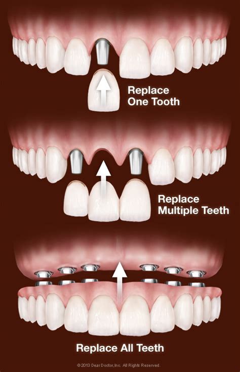 Dental Implants Drexel Hill PA Bloomfield Dental