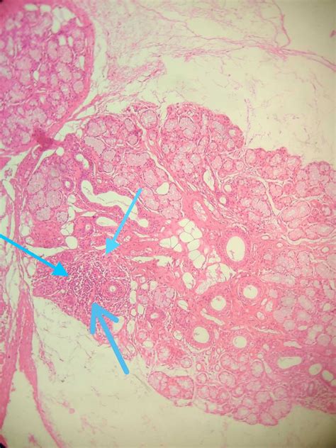 Primary Sjogrens Syndrome Presenting As An Isolated Severe Autonomic