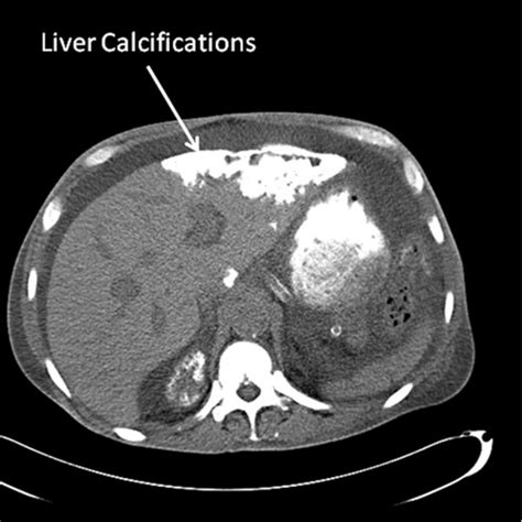 Ct Of The Abdomen With Po Contrast Arrow Shows Liver Calcifications Download Scientific Diagram