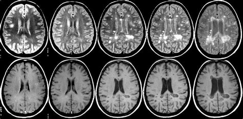 Mri Brain Scan Ms