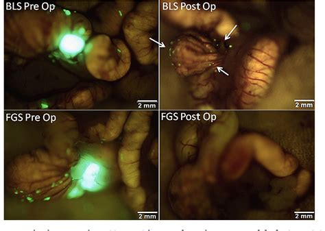 Figure 1 From Fluorescence Guided Surgery Of Human Colon Cancer