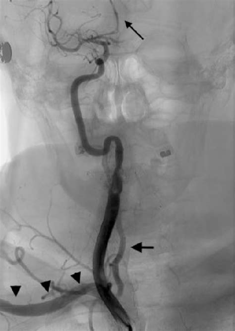 Selective Angiography Of The Innominate Artery Following Endovascular