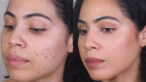 Covering Acne Scars And Hyperpigmentation Using Clean Drugstore Makeup