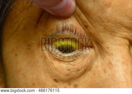 Deep Jaundice Asian Image Photo Free Trial Bigstock