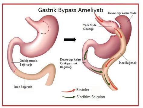 Gastrik bypass ameliyatı hakkında