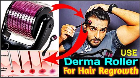 Derma Roller For Hair Growth How To Use Derma Roller For Hair Regrowth In Hindi Aamir