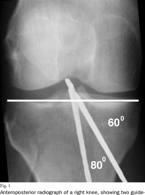 Figure 1 From Effect Of The Angle Of The Femoral And Tibial Tunnels In