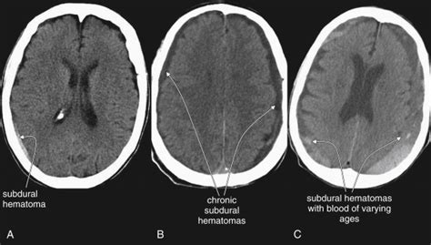 Imaging The Head And Brain Radiology Key