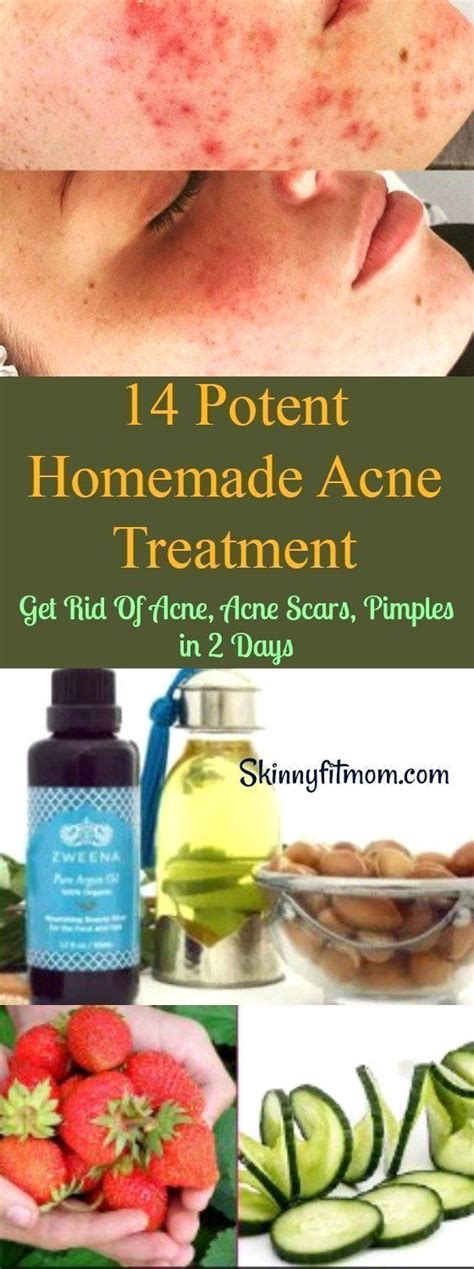 Top 5 Back Acne Treatments Food Blog