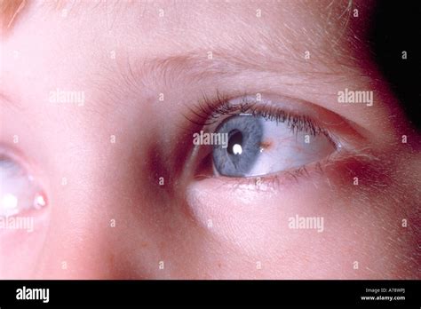 MALIGNANT MELANOMA OF CORNEAL LIMBUS Stock Photo Alamy