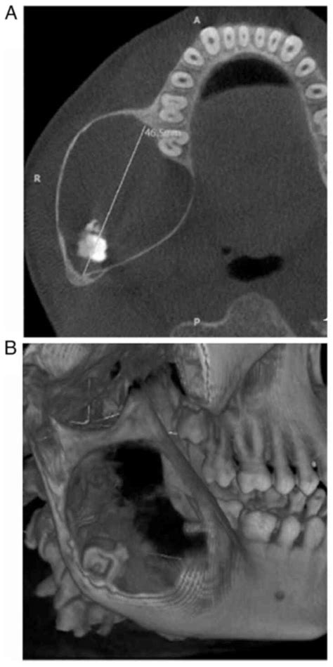 Ameloblastic Fibroodontoma In The Posterior Mandible A Case Report