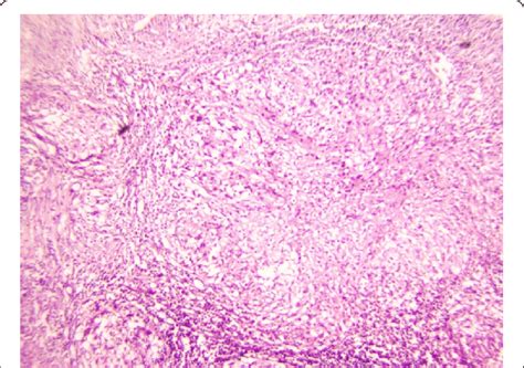 Photomicrograph Showing Granulomatous Inflammation In Testicular