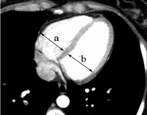 Right To Left Ventricular Ratio Ab Was Calculated On An Axial Download Scientific Diagram