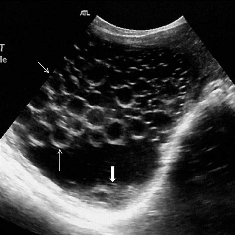 Ultrasound Image Showing Typical Multivesicular Hydatid Cyst In The