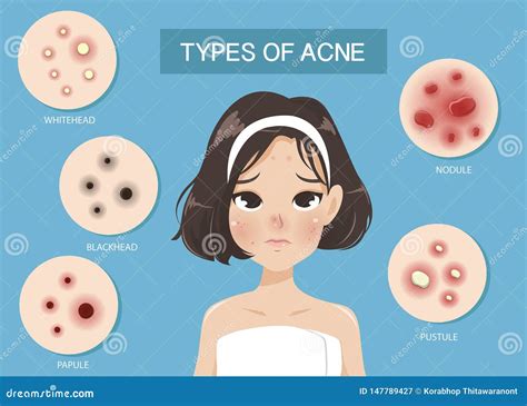 Types Of Acne By Woman Stock Vector Illustration Of Beautiful 147789427