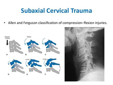 Cervical Fractures