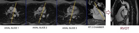 Cardiac Mri Protocols Planning And Techniques Positioning For