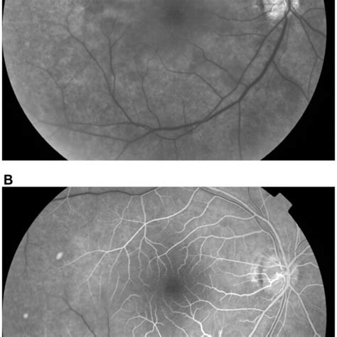 Color photograph of the right fundus showing a cherry-red spot in the ...