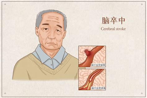 冬春交替，谨防“脑卒中”这个头号杀手 青岛新闻网