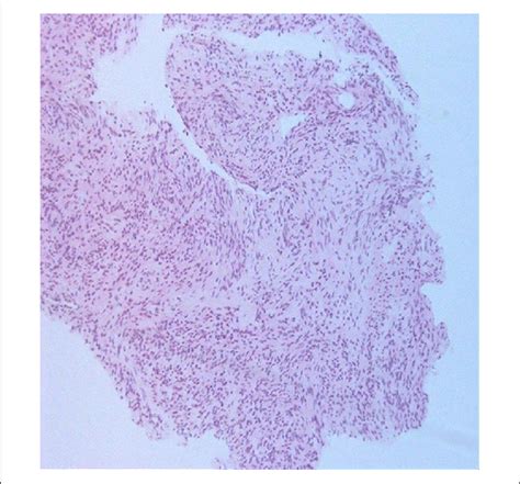 Low Power Microscopy Tissue Biopsy Showing Welldifferentiated Smooth