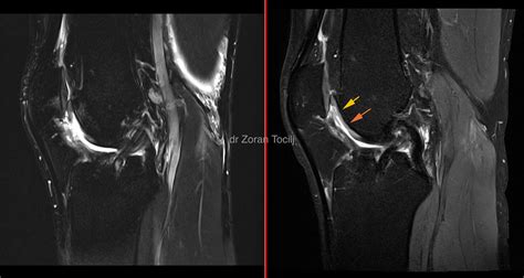 Cartilage regeneration – knee cartilage regeneration – Dr Zoran Tocilj