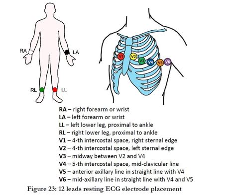 12 Lead Ecg Placement Mnemonic