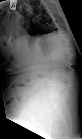 Wk 9 Thoracic And Lumbar Anomalies And Variants Flashcards Quizlet