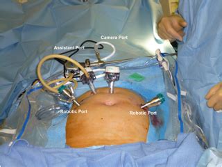 Society Of Laparoscopic Robotic Surgeons Laparoscopic Lymphadenectomy