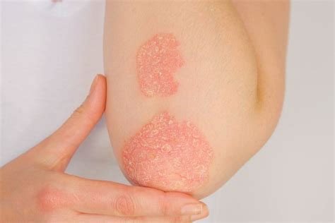 Foto Mengenal Psoriasis Jenis Penyebab Pencegahan Dan Pengobatannya